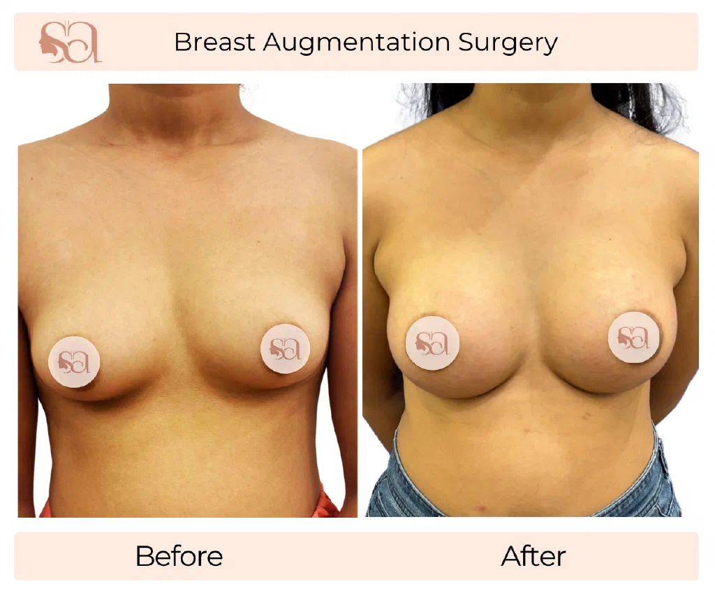 Breast Augmentation before and after result