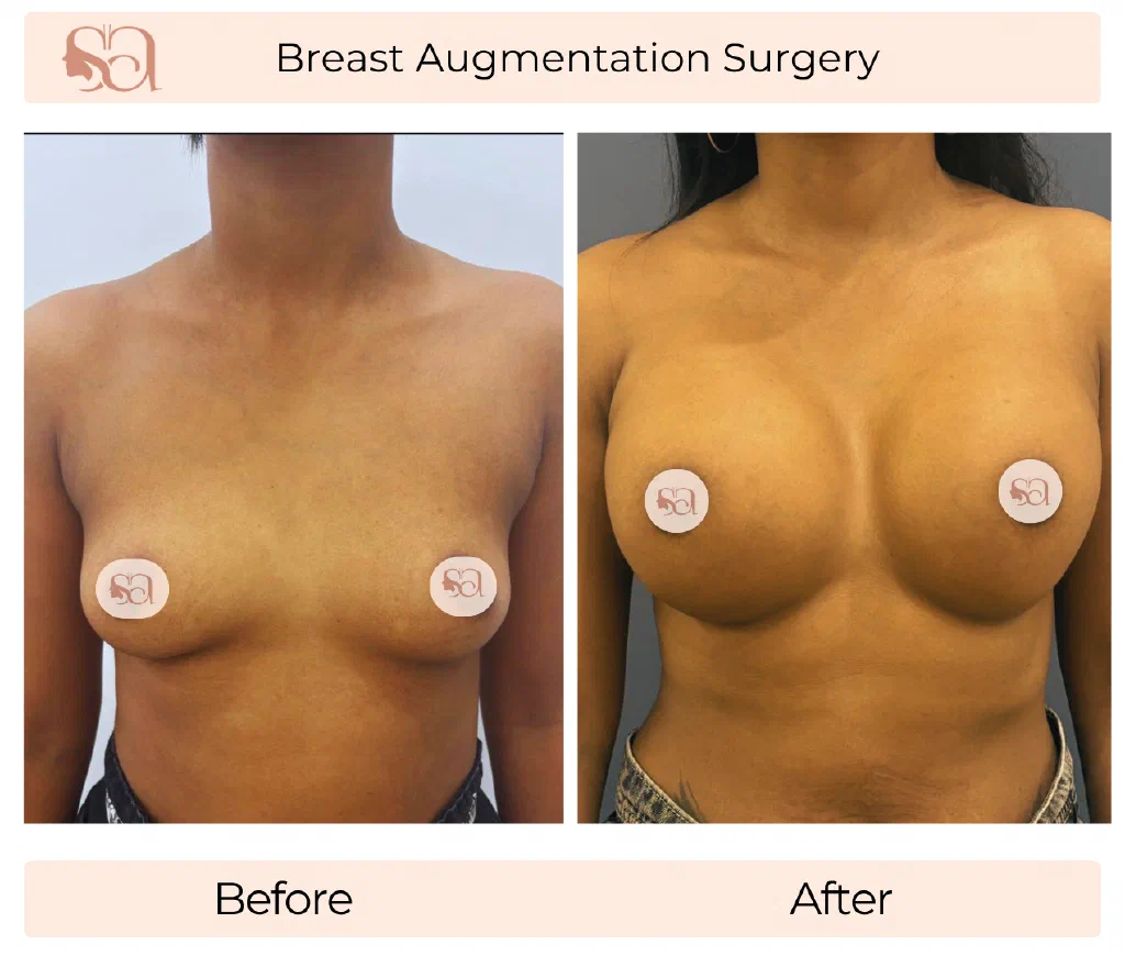 Breast Augmentation before and after result