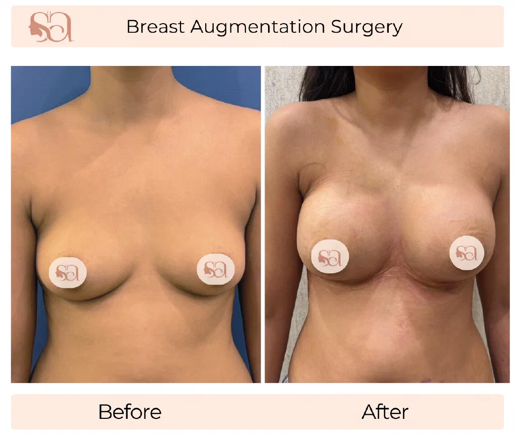 Breast Augmentation before and after result