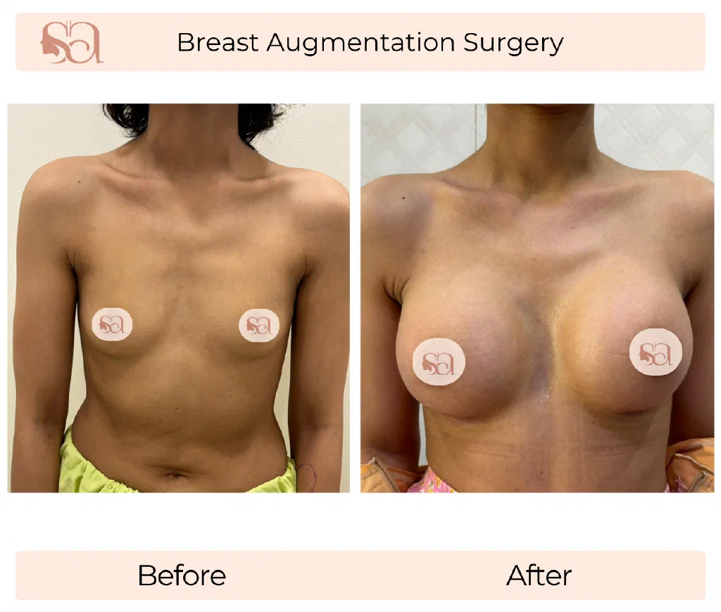 Breast Augmentation before and after result