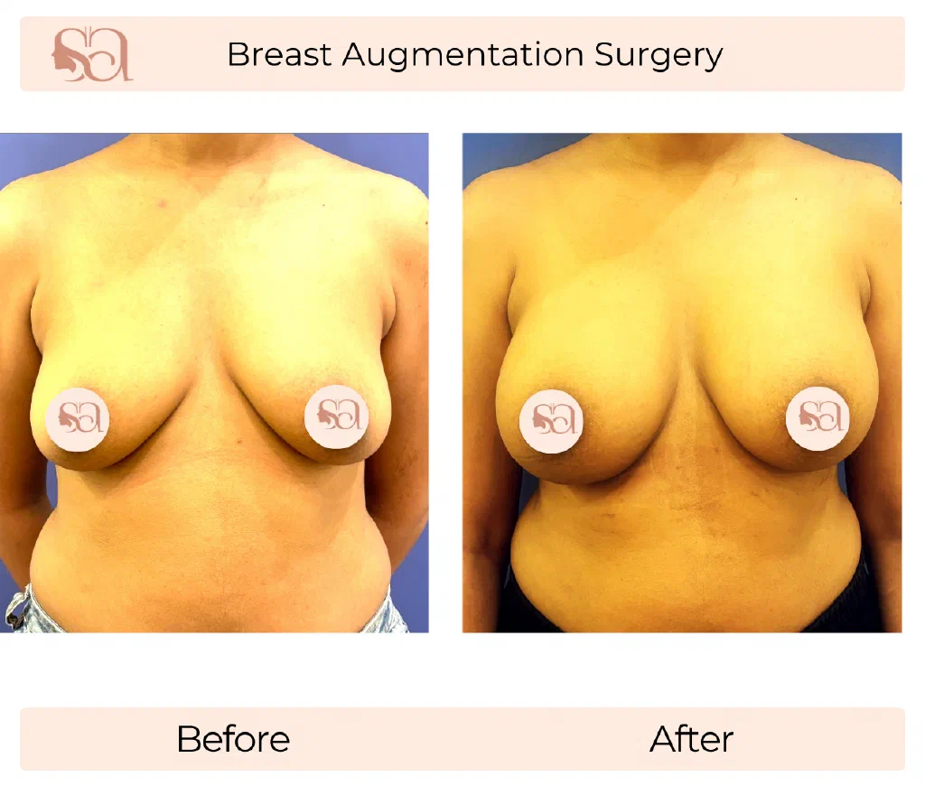 Breast Augmentation before and after result