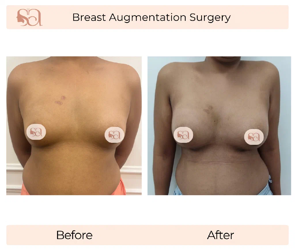Breast Augmentation before and after result