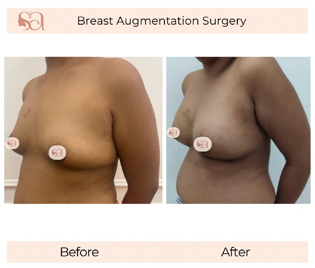 Breast Augmentation before and after result