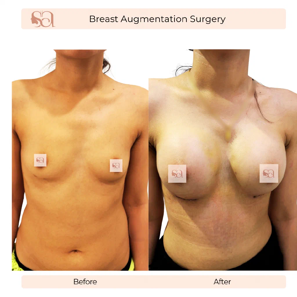 Breast Augmentation before and after result