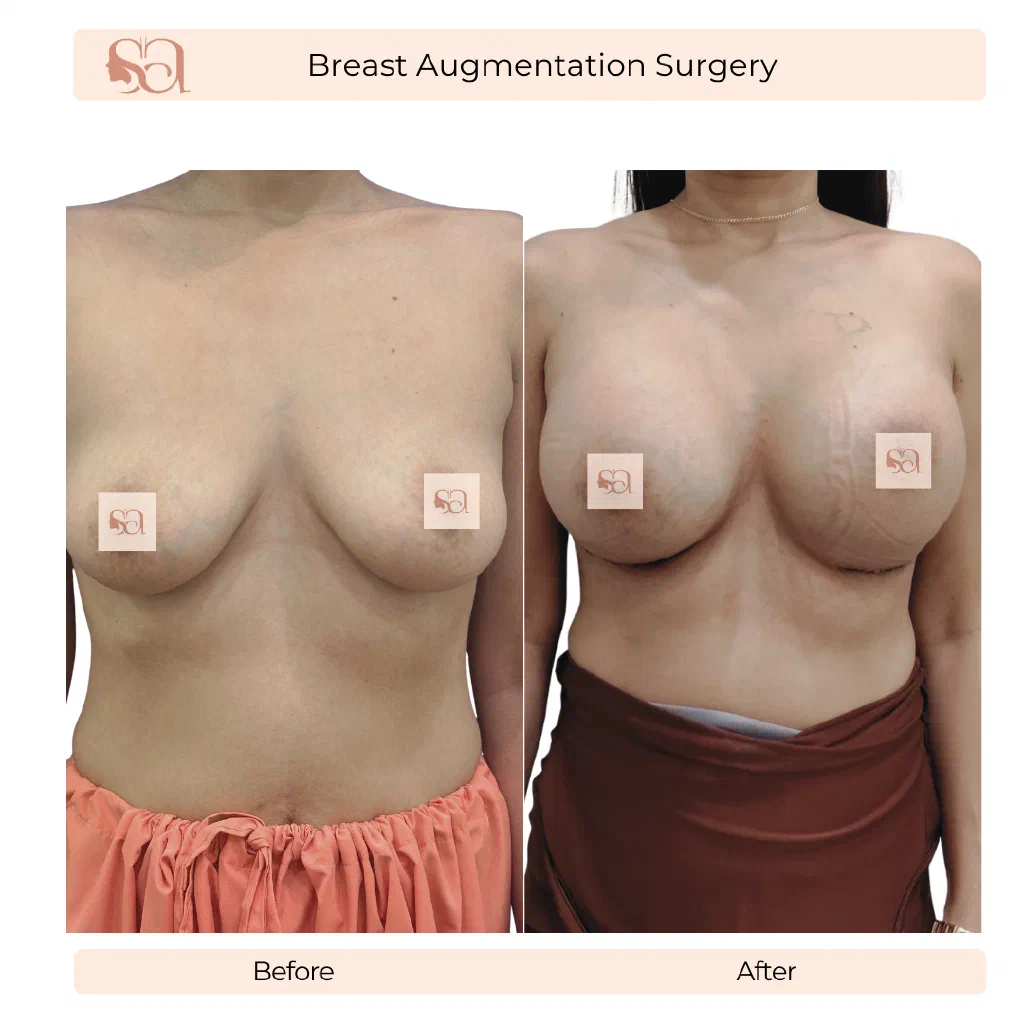 Breast Augmentation before and after result