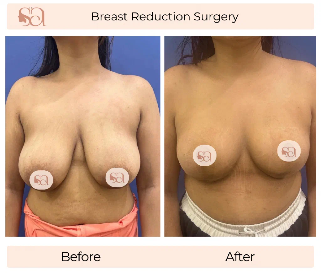 Breast Reduction before and after result