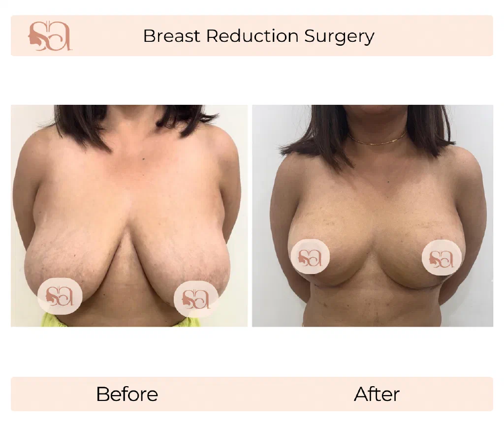 Breast Reduction before and after result
