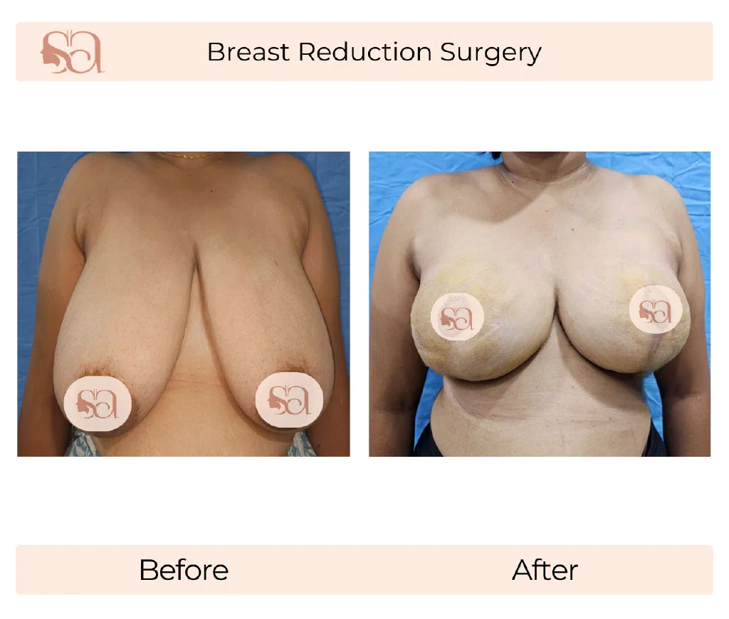 Breast Reduction before and after result