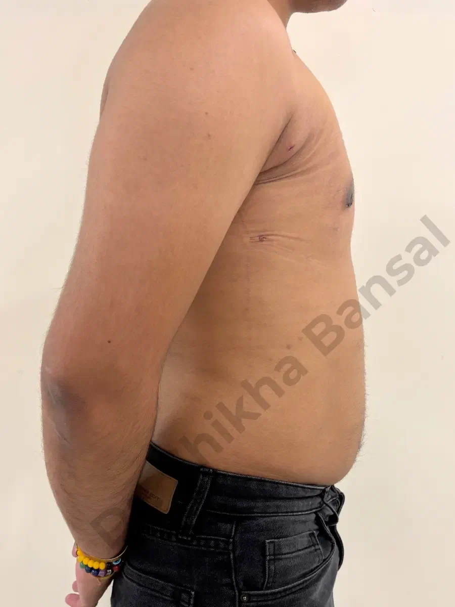 After photo for Gynecomastia Surgery