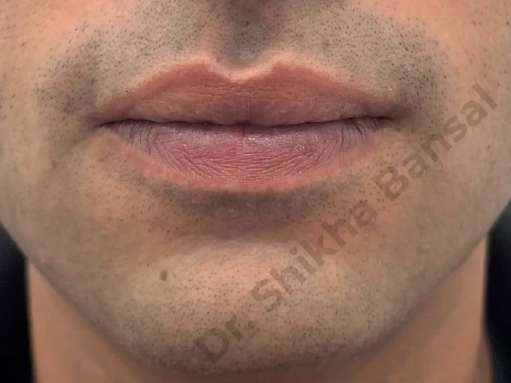 After photo for Lip Reduction