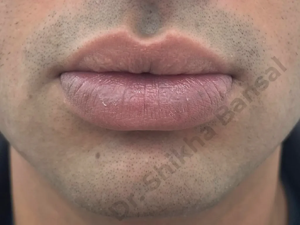 Before - Lip Reduction