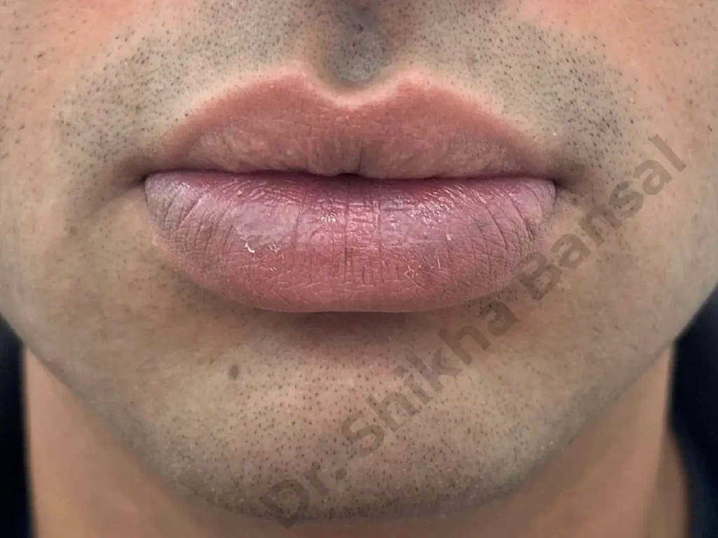 Before - Lip Reduction