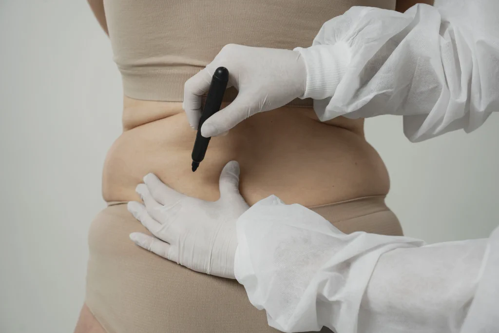 Fat Grafting Procedure