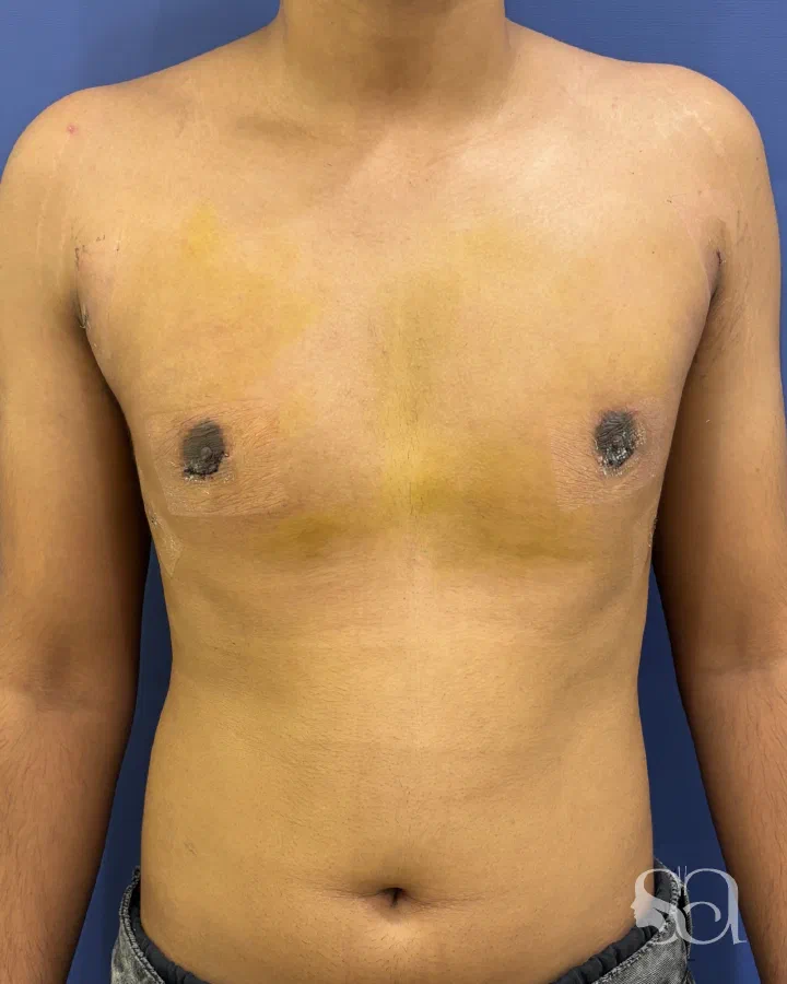 After: gynecomastia surgery, 7 days after surgery