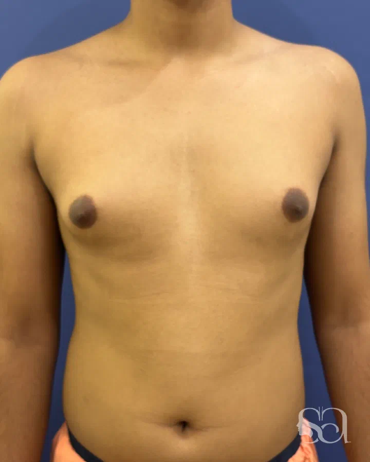 Before: gynecomastia surgery, 7 days after surgery