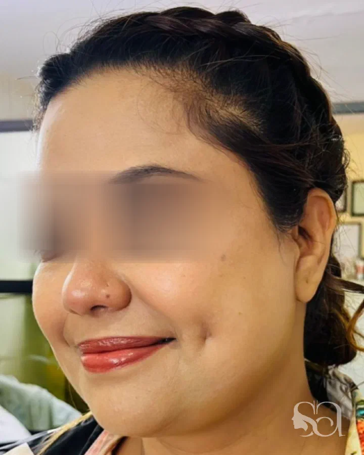 After: dimple creation