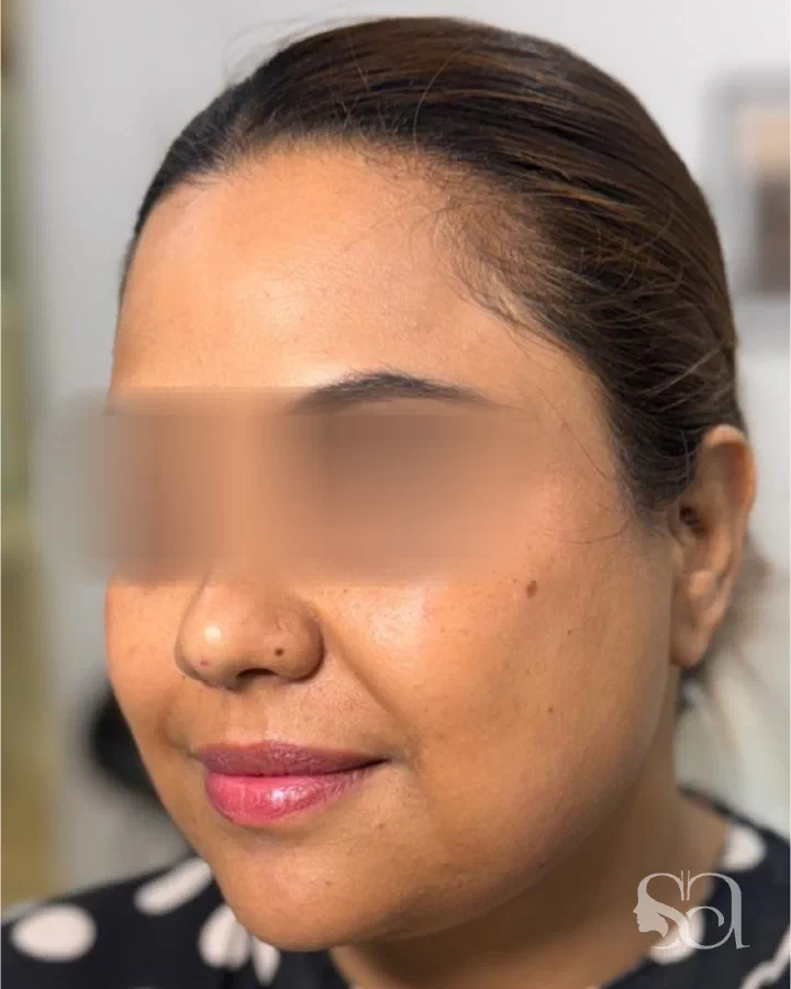 Before: dimple creation