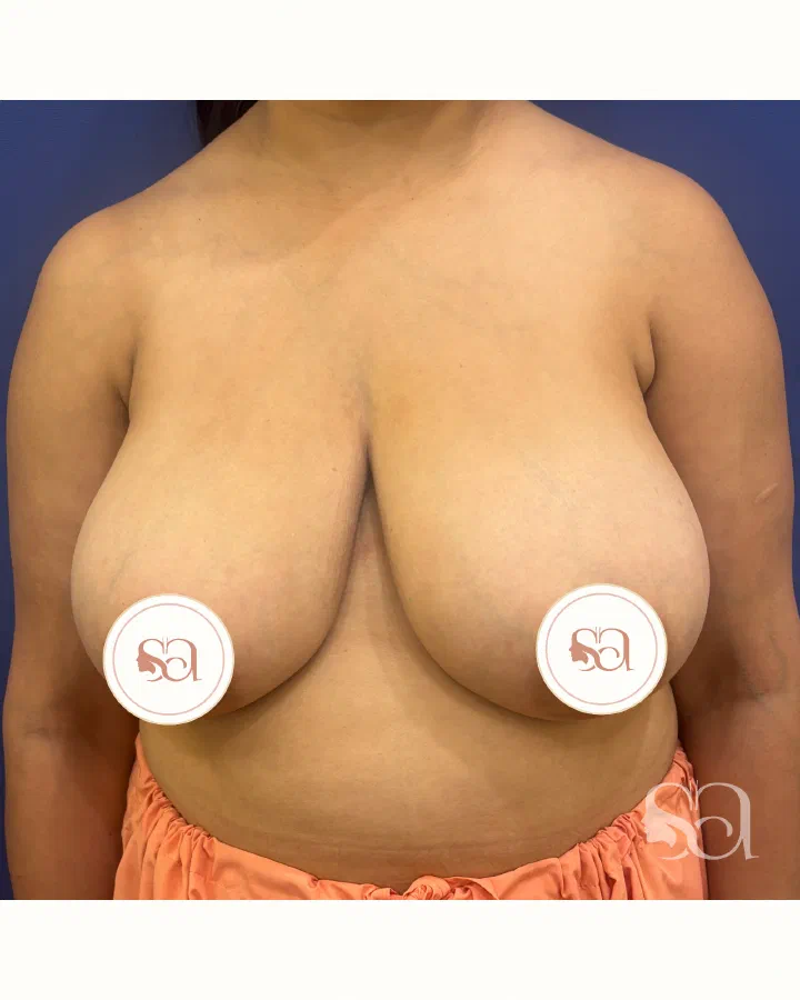 Before: breast reduction, 3 weeks after surgery