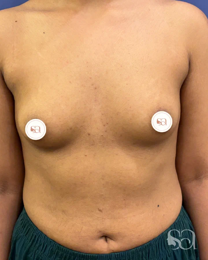 Before: breast augmentation, 2 weeks after surgery