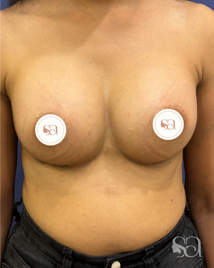 After: breast augmentation, 3 weeks after surgery