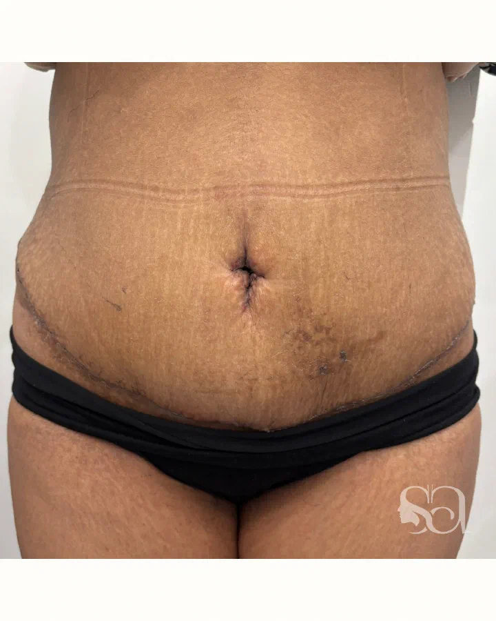 After: tummy tuck (abdominoplasty), 4 weeks after surgery