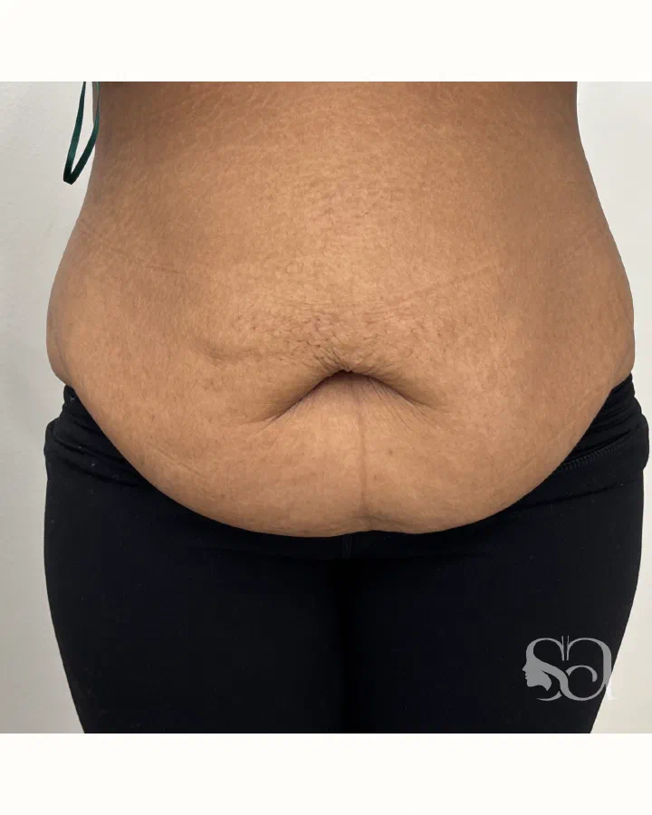 Before: tummy tuck (abdominoplasty), 4 weeks after surgery