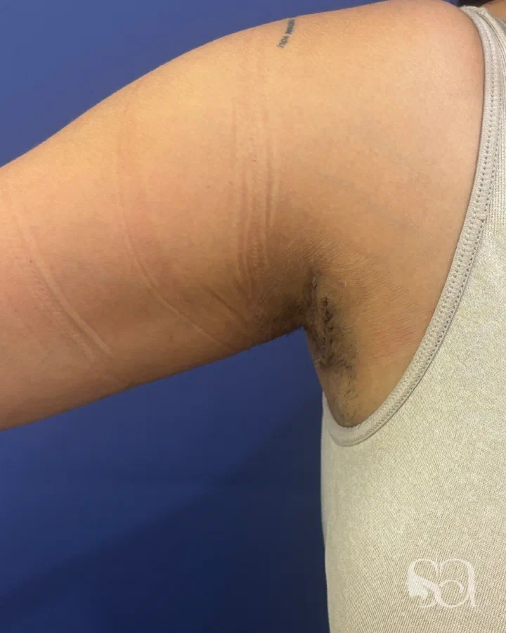 After: axillary breast removal, 9 days after surgery