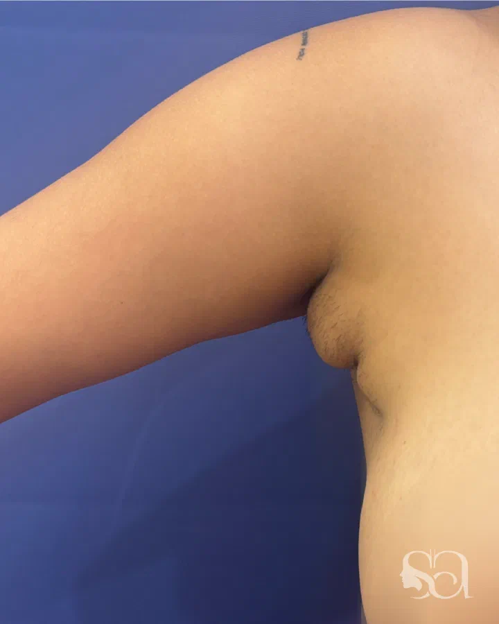 Before: axillary breast removal, 9 days after surgery