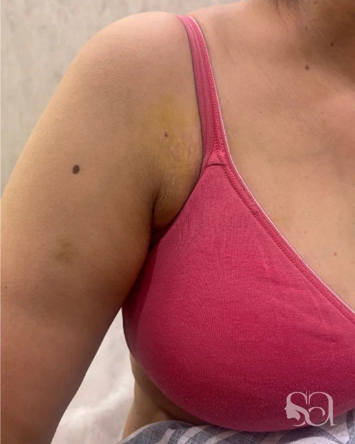 After: axillary breast removal, 2 weeks after surgery