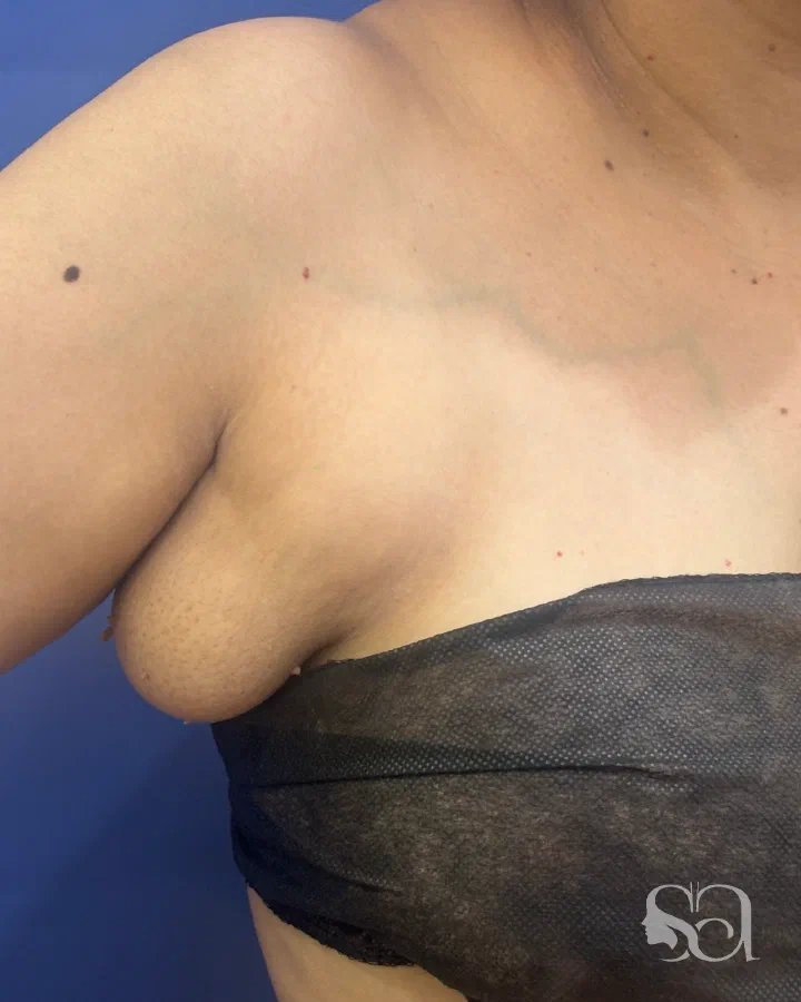 Before: axillary breast removal, 2 weeks after surgery