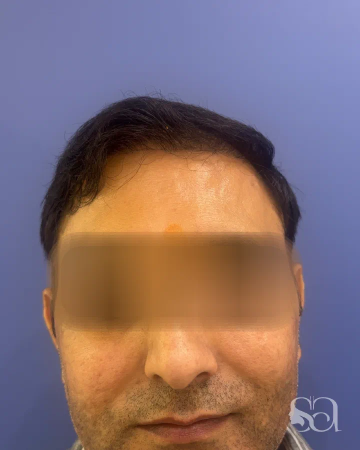 After: hair transplant, 1.1 years after surgery