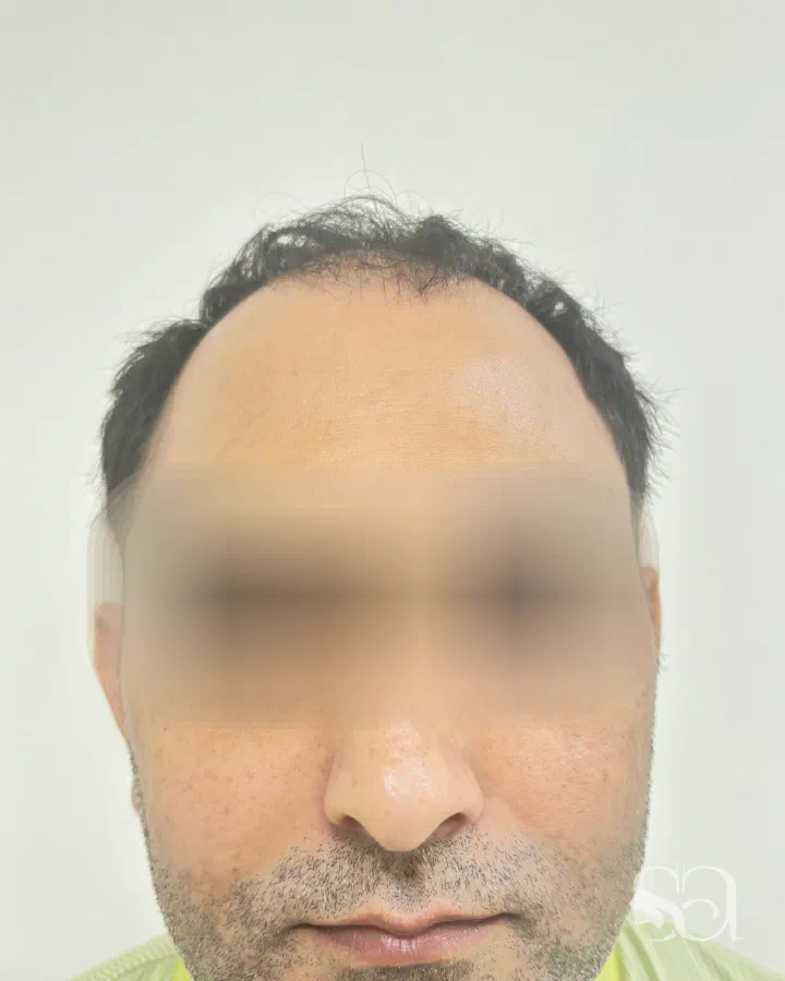 Before: hair transplant, 1.1 years after surgery