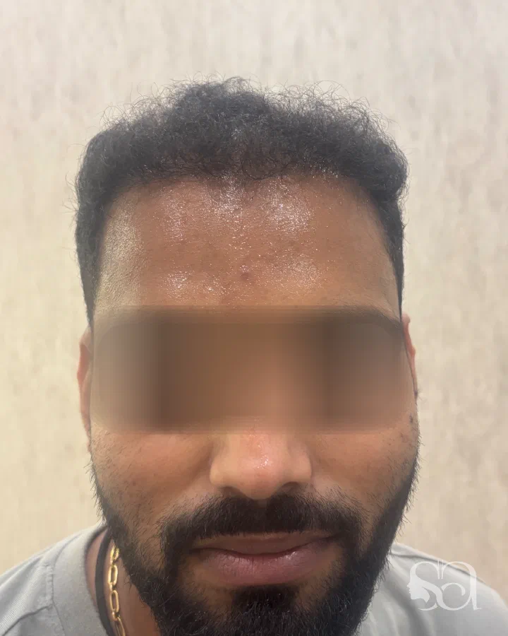 After: hair transplant, 7 months after surgery