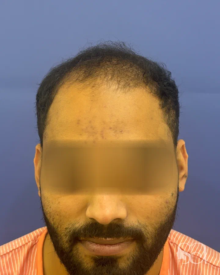 Before: hair transplant, 7 months after surgery