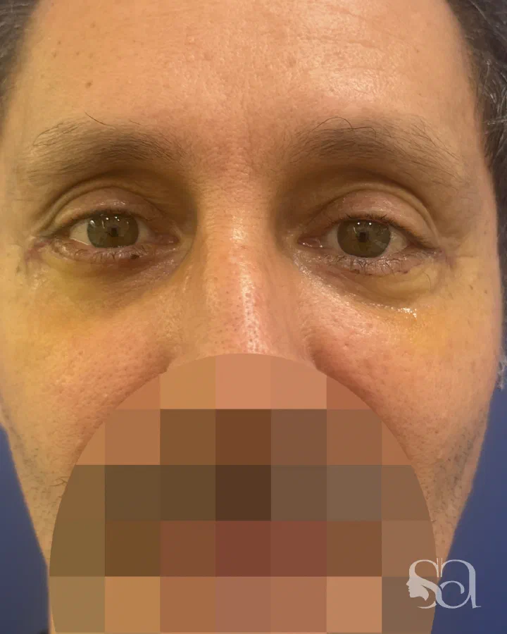 After: blepharoplasty, 7 days after surgery