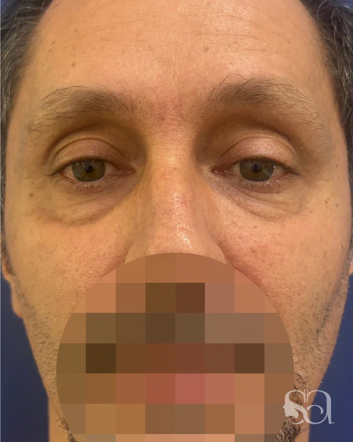 Before: blepharoplasty, 7 days after surgery