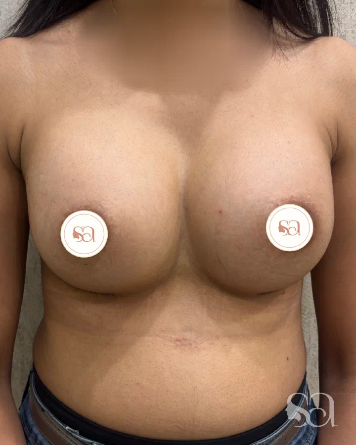 After: breast augmentation, 2 weeks after surgery