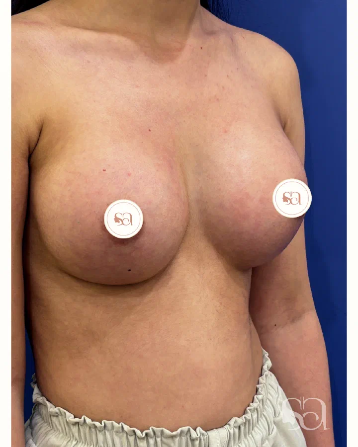 After: breast augmentation, 5 weeks after surgery