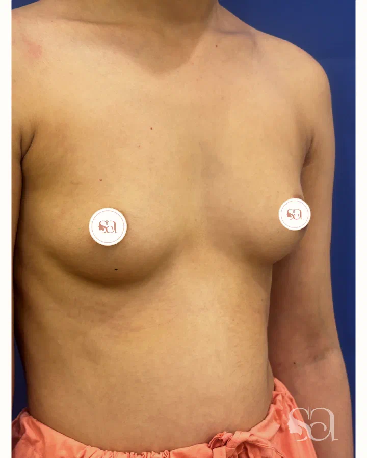 Before: breast augmentation, 5 weeks after surgery