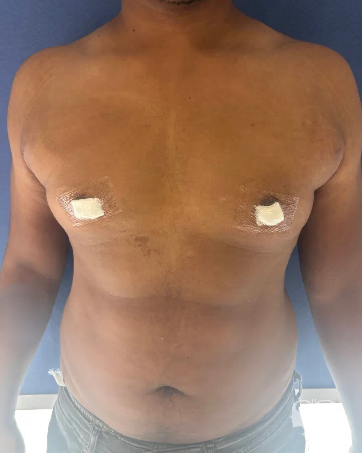 After: gynecomastia surgery, 11 days after surgery