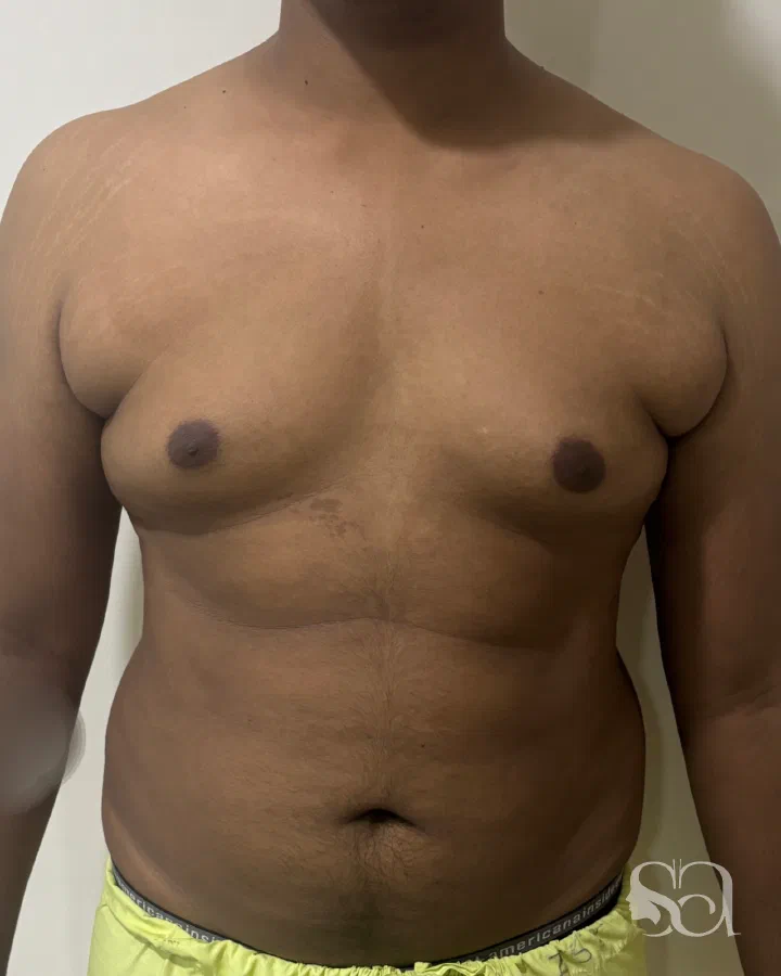 Before: gynecomastia surgery, 11 days after surgery