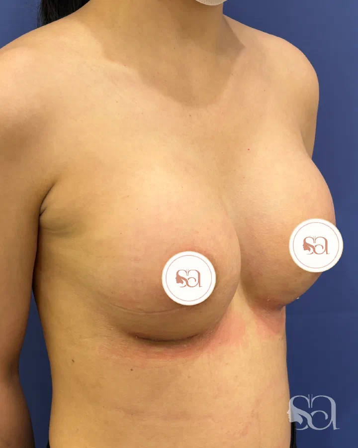 After: breast augmentation, 3 weeks after surgery