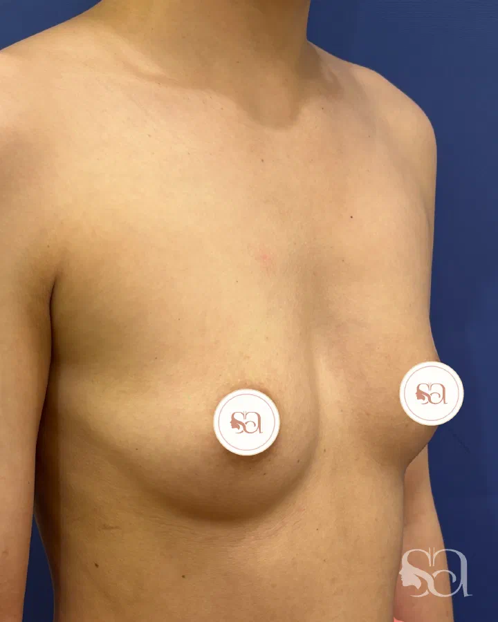 Before: breast augmentation, 3 weeks after surgery