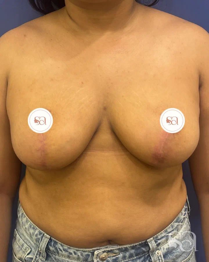 After: breast reduction, 3 months after surgery