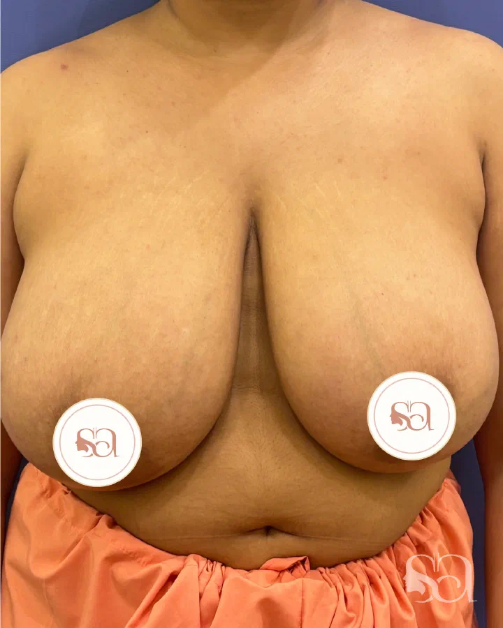 Before: breast reduction, 3 months after surgery