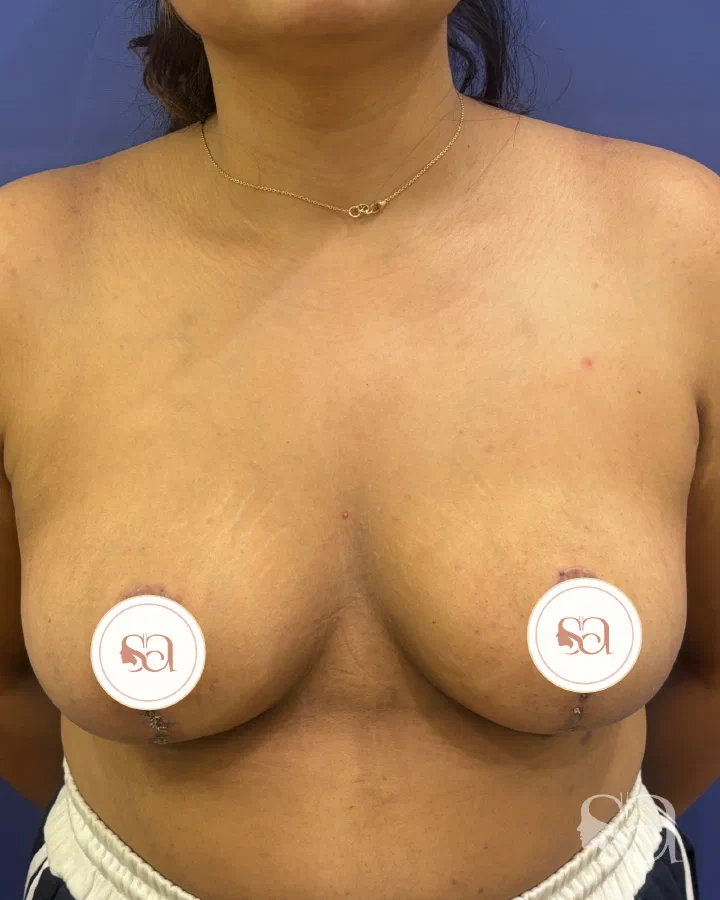 After: breast reduction, 8 weeks after surgery