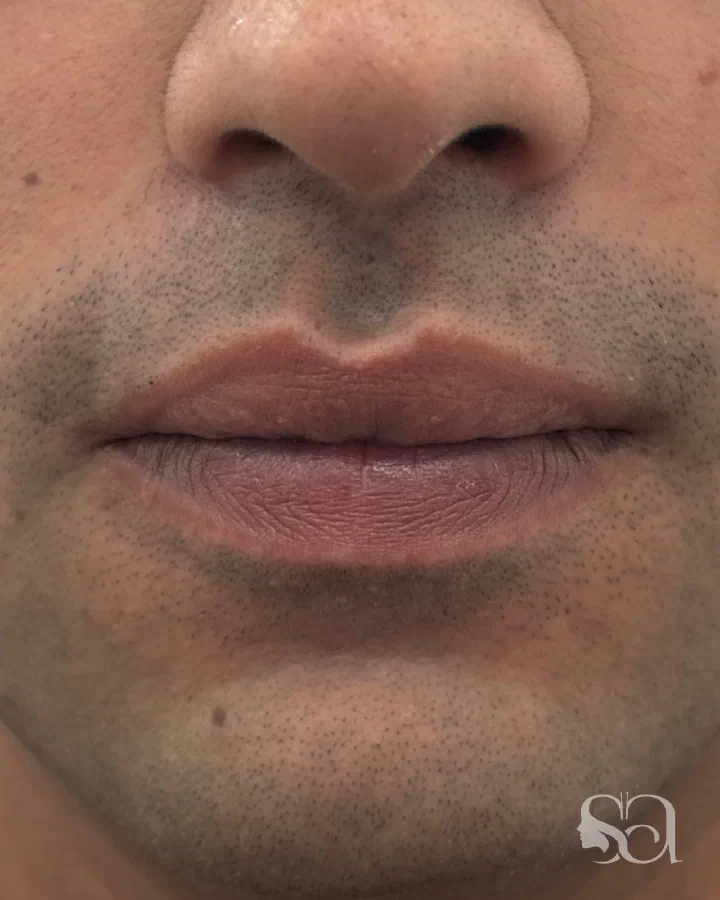 After: lip reduction