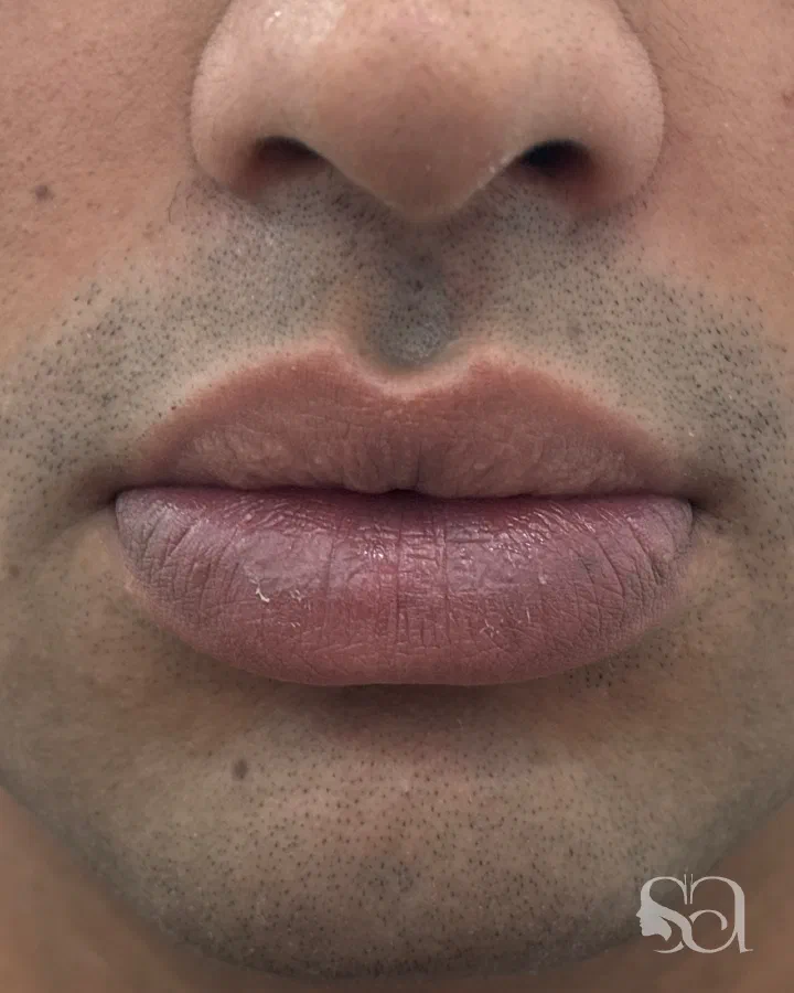 Before: lip reduction